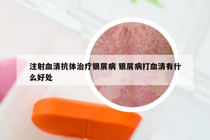 注射血清抗体治疗银屑病 银屑病打血清有什么好处
