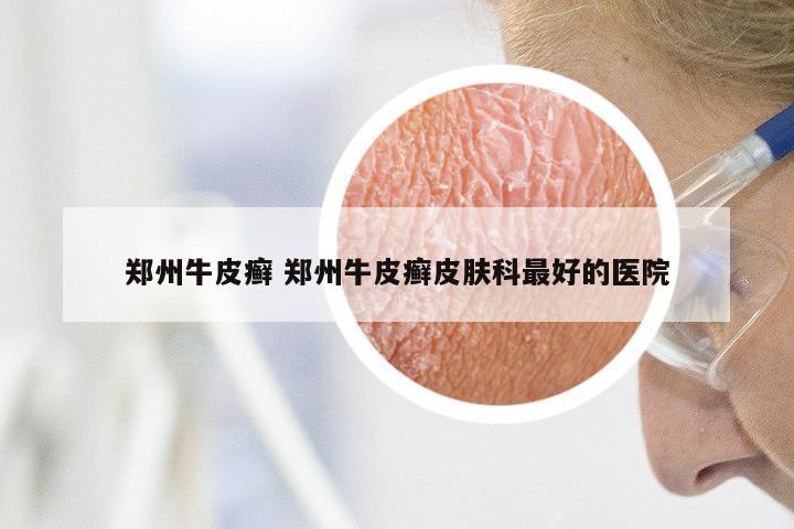 郑州牛皮癣 郑州牛皮癣皮肤科最好的医院