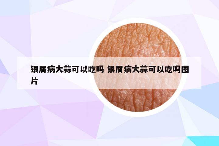 银屑病大蒜可以吃吗 银屑病大蒜可以吃吗图片
