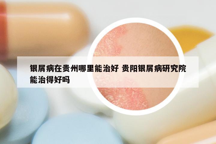 银屑病在贵州哪里能治好 贵阳银屑病研究院能治得好吗