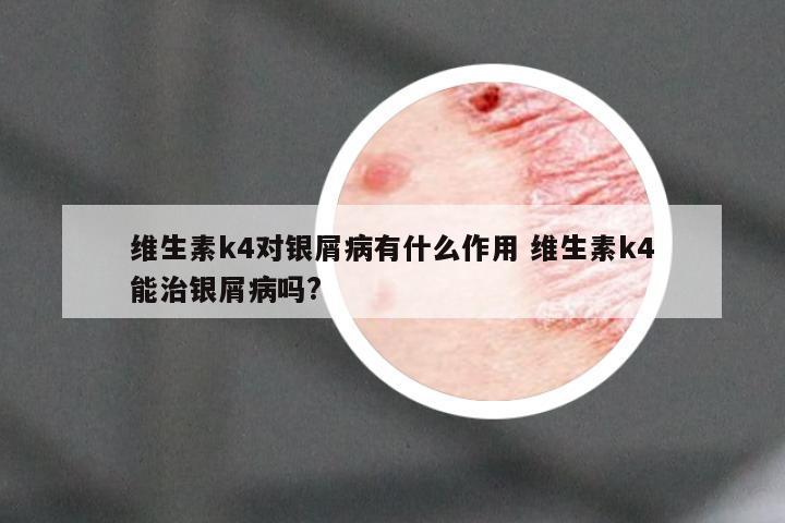 维生素k4对银屑病有什么作用 维生素k4能治银屑病吗?
