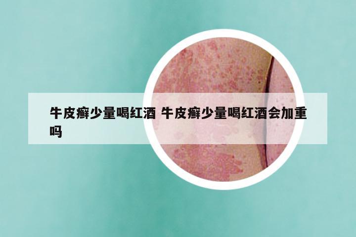 牛皮癣少量喝红酒 牛皮癣少量喝红酒会加重吗