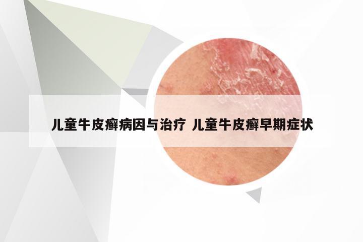 儿童牛皮癣病因与治疗 儿童牛皮癣早期症状