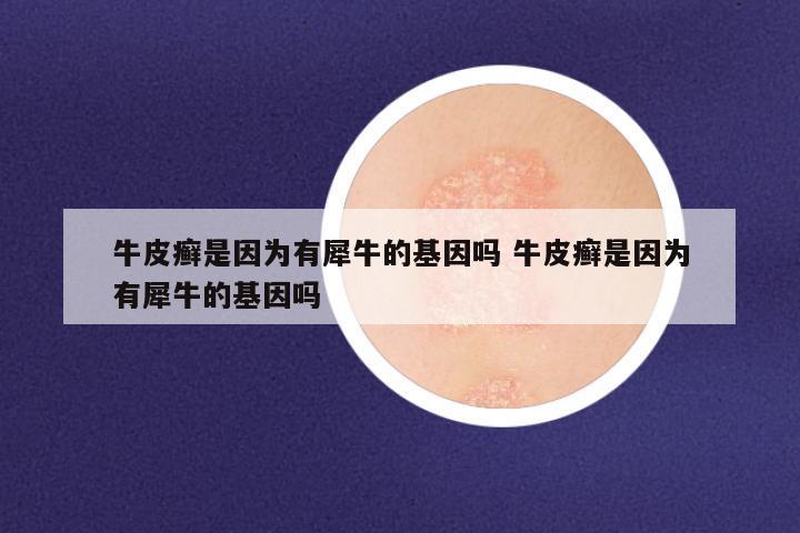 牛皮癣是因为有犀牛的基因吗 牛皮癣是因为有犀牛的基因吗