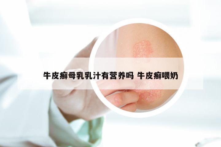 牛皮癣母乳乳汁有营养吗 牛皮癣喂奶