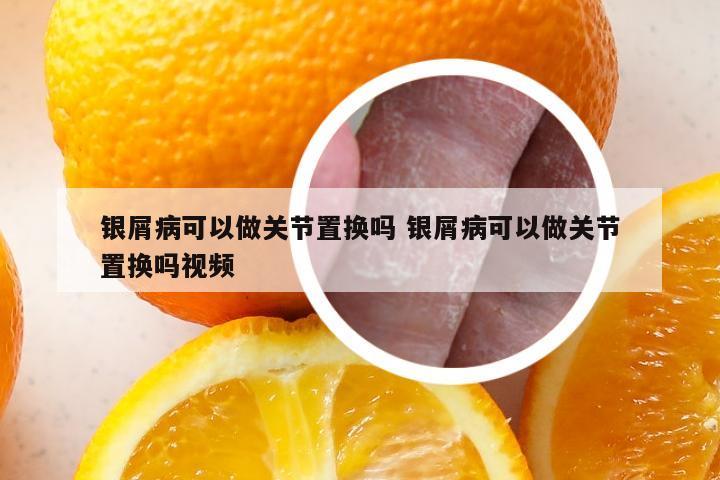 银屑病可以做关节置换吗 银屑病可以做关节置换吗视频