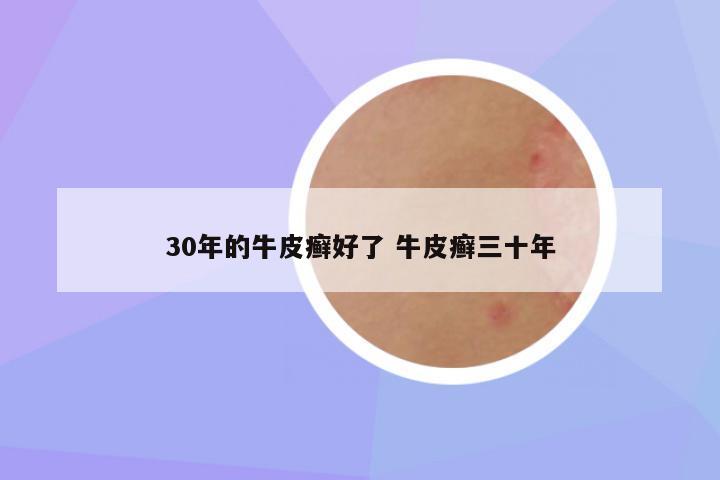 30年的牛皮癣好了 牛皮癣三十年