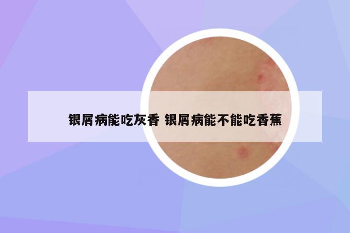 银屑病能吃灰香 银屑病能不能吃香蕉