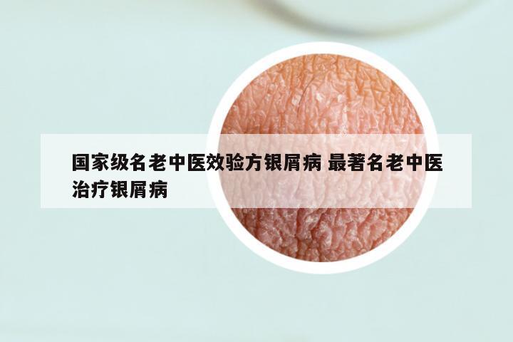 国家级名老中医效验方银屑病 最著名老中医治疗银屑病