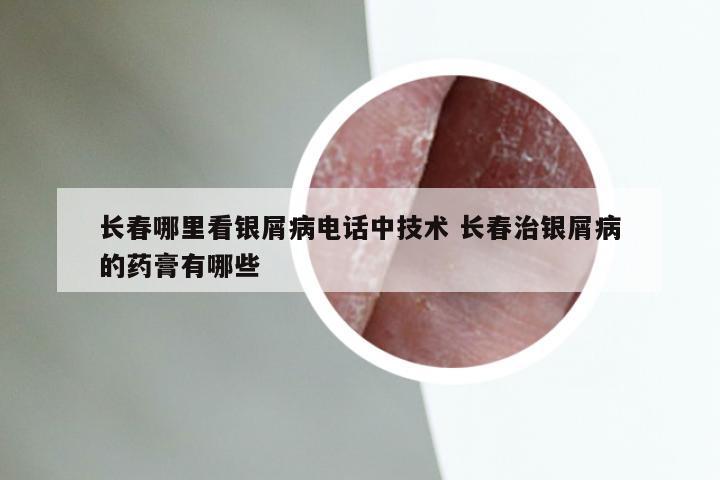 长春哪里看银屑病电话中技术 长春治银屑病的药膏有哪些