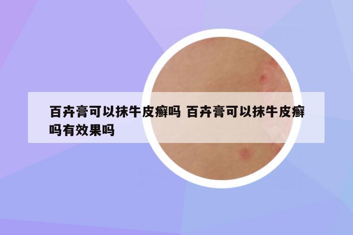 百卉膏可以抹牛皮癣吗 百卉膏可以抹牛皮癣吗有效果吗