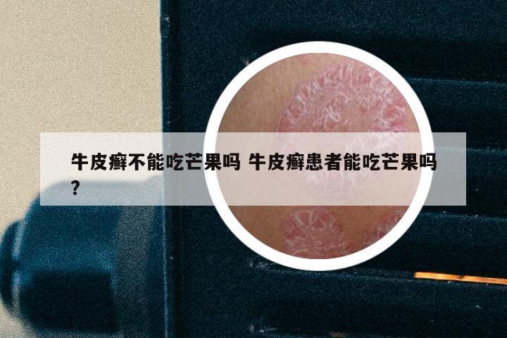 牛皮癣不能吃芒果吗 牛皮癣患者能吃芒果吗?