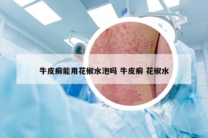 牛皮癣能用花椒水泡吗 牛皮癣 花椒水