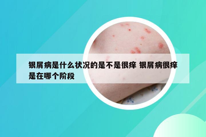 银屑病是什么状况的是不是很痒 银屑病很痒是在哪个阶段