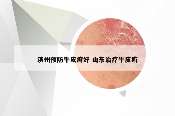 滨州预防牛皮癣好 山东治疗牛皮癣