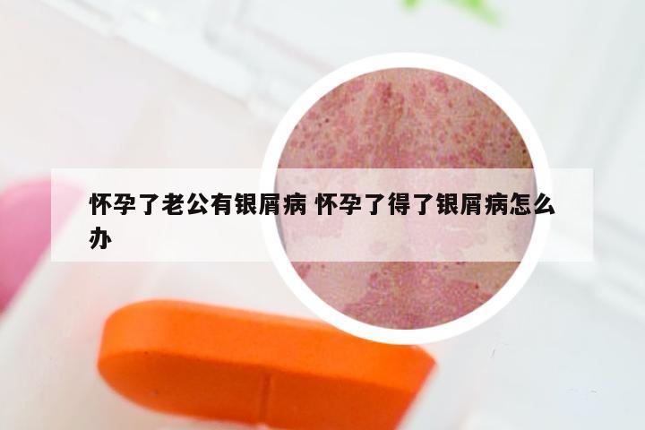 怀孕了老公有银屑病 怀孕了得了银屑病怎么办
