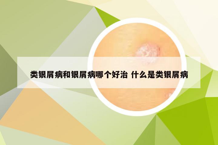 类银屑病和银屑病哪个好治 什么是类银屑病
