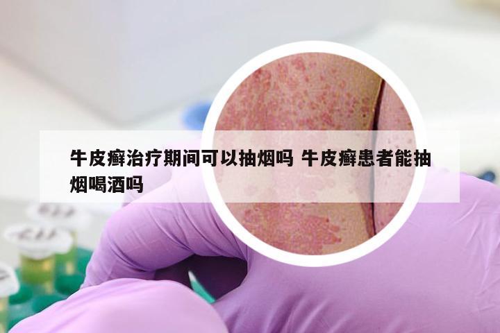 牛皮癣治疗期间可以抽烟吗 牛皮癣患者能抽烟喝酒吗