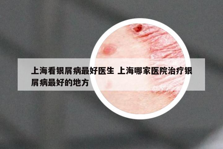 上海看银屑病最好医生 上海哪家医院治疗银屑病最好的地方