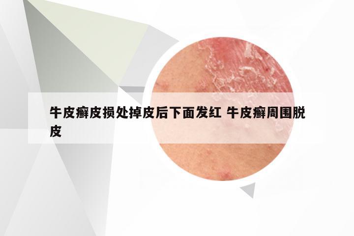 牛皮癣皮损处掉皮后下面发红 牛皮癣周围脱皮