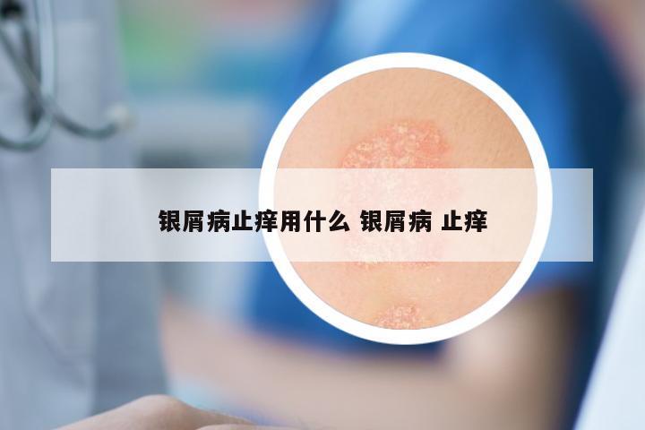 银屑病止痒用什么 银屑病 止痒