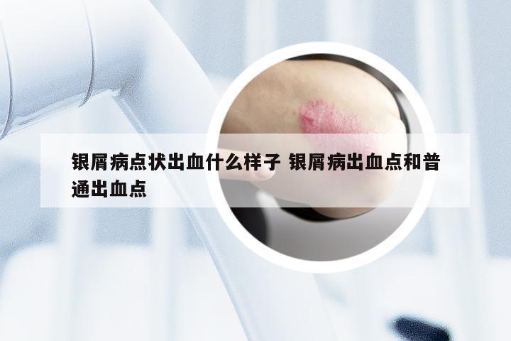 银屑病点状出血什么样子 银屑病出血点和普通出血点