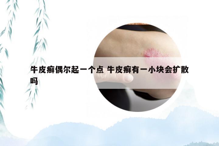 牛皮癣偶尔起一个点 牛皮癣有一小块会扩散吗