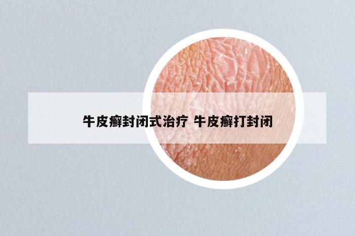 牛皮癣封闭式治疗 牛皮癣打封闭