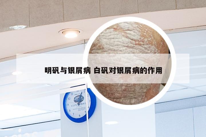 明矾与银屑病 白矾对银屑病的作用