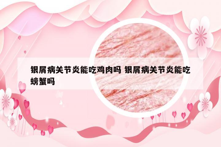 银屑病关节炎能吃鸡肉吗 银屑病关节炎能吃螃蟹吗