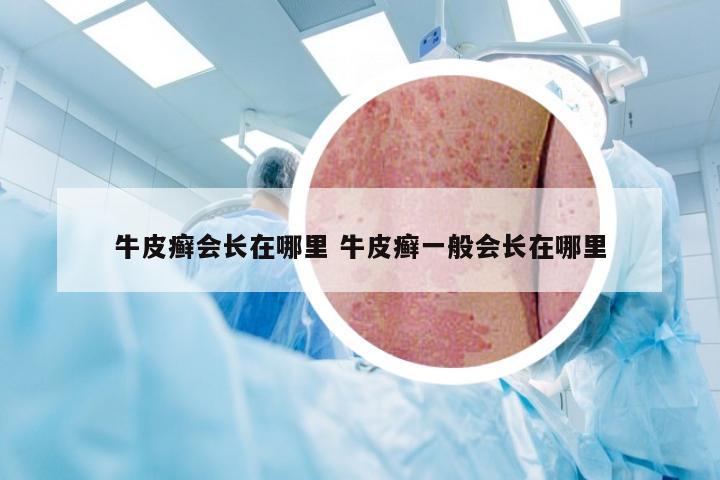 牛皮癣会长在哪里 牛皮癣一般会长在哪里