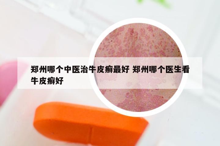 郑州哪个中医治牛皮癣最好 郑州哪个医生看牛皮癣好