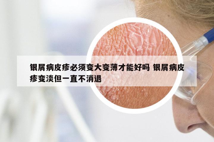 银屑病皮疹必须变大变薄才能好吗 银屑病皮疹变淡但一直不消退