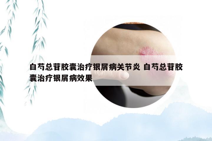 白芍总苷胶囊治疗银屑病关节炎 白芍总苷胶囊治疗银屑病效果