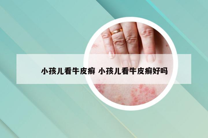 小孩儿看牛皮癣 小孩儿看牛皮癣好吗