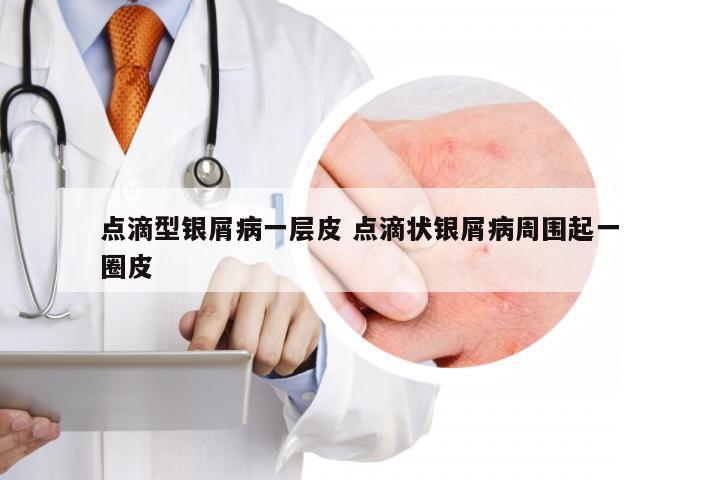 点滴型银屑病一层皮 点滴状银屑病周围起一圈皮
