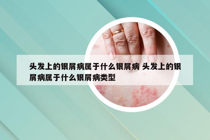 头发上的银屑病属于什么银屑病 头发上的银屑病属于什么银屑病类型