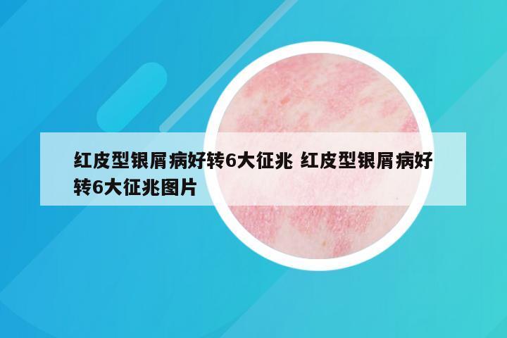 红皮型银屑病好转6大征兆 红皮型银屑病好转6大征兆图片