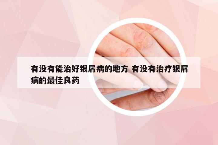 有没有能治好银屑病的地方 有没有治疗银屑病的最佳良药