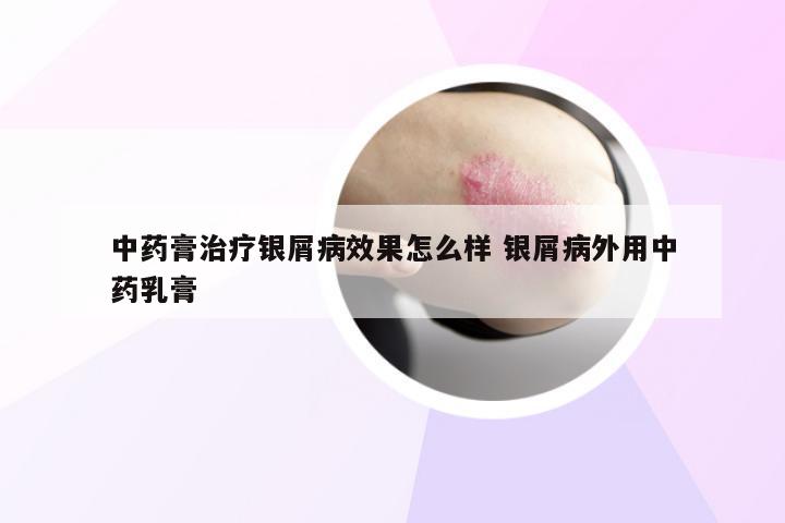 中药膏治疗银屑病效果怎么样 银屑病外用中药乳膏