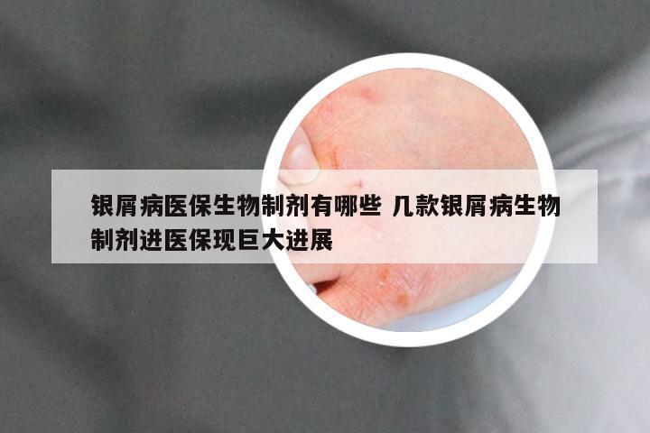 银屑病医保生物制剂有哪些 几款银屑病生物制剂进医保现巨大进展