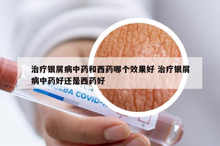 治疗银屑病中药和西药哪个效果好 治疗银屑病中药好还是西药好
