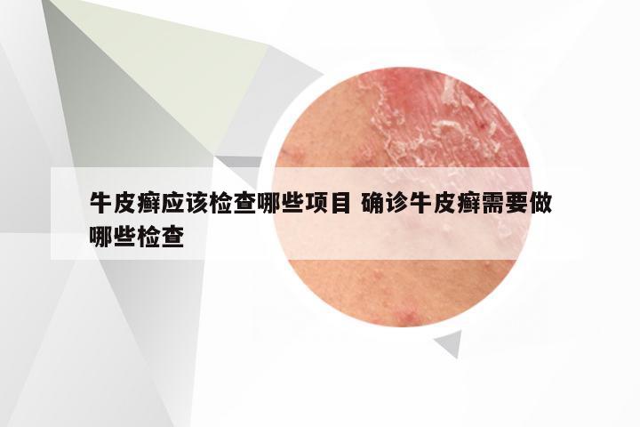 牛皮癣应该检查哪些项目 确诊牛皮癣需要做哪些检查