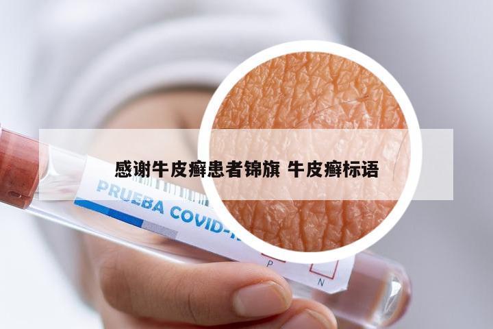 感谢牛皮癣患者锦旗 牛皮癣标语