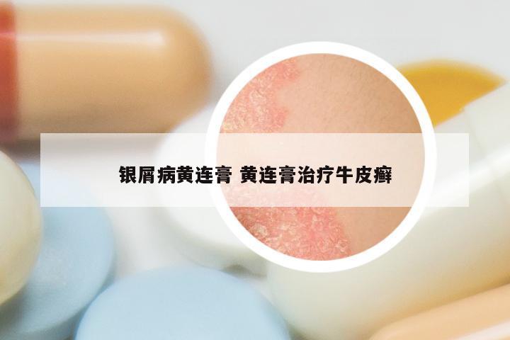 银屑病黄连膏 黄连膏治疗牛皮癣