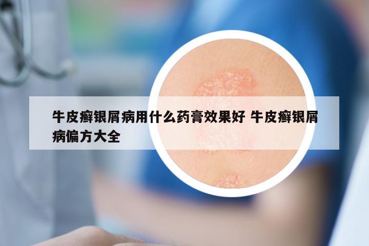 牛皮癣银屑病用什么药膏效果好 牛皮癣银屑病偏方大全