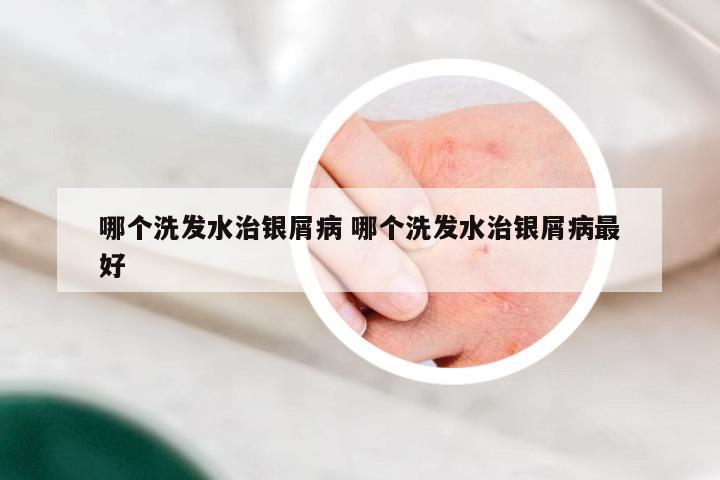 哪个洗发水治银屑病 哪个洗发水治银屑病最好
