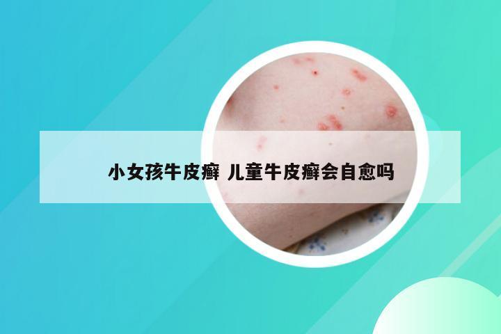 小女孩牛皮癣 儿童牛皮癣会自愈吗
