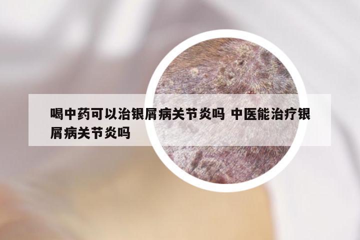 喝中药可以治银屑病关节炎吗 中医能治疗银屑病关节炎吗
