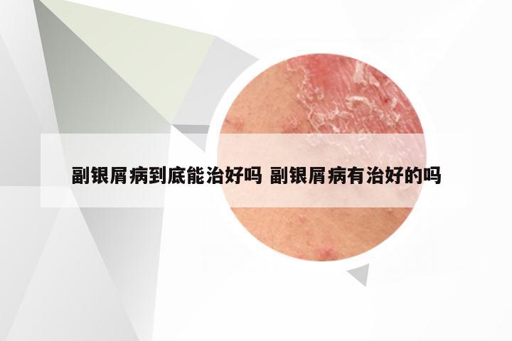 副银屑病到底能治好吗 副银屑病有治好的吗